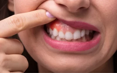 Side effects of home teeth whitening kits