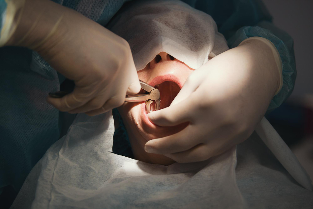 Third Molar Surgery