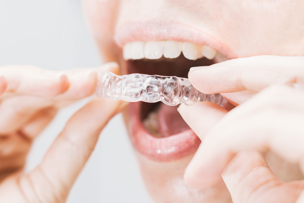 Invisalign
