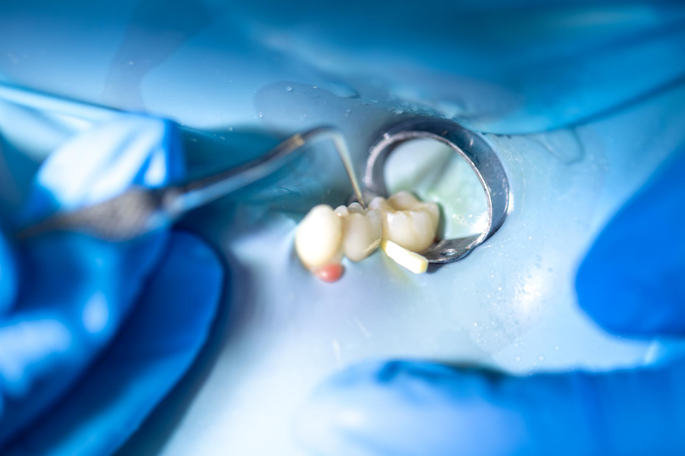 Third Molar Surgery