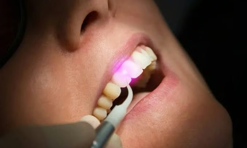 Lasers in Dentistry: Revolutionizing Oral Care