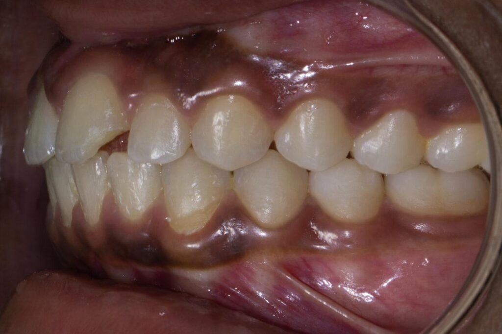 Orthodontic Treatment