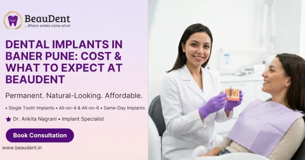Dental IMplants in Baner Pune
